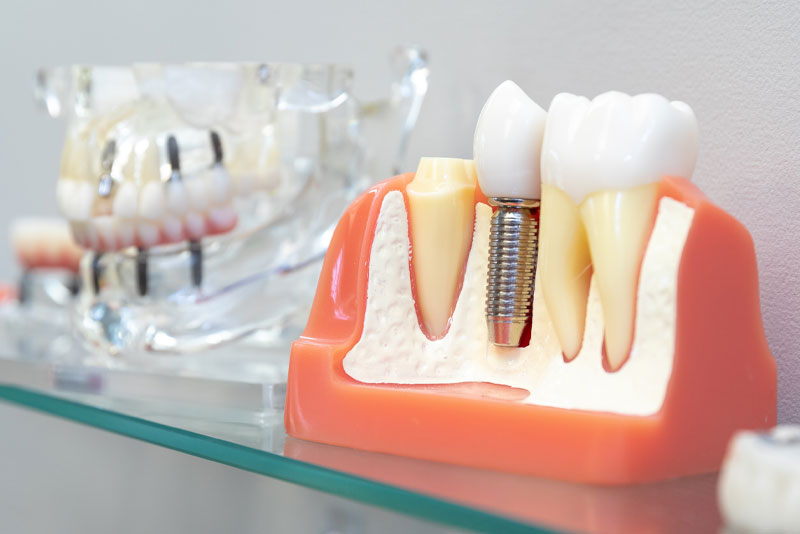 dental implant model.