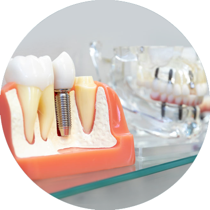 dental implants.
