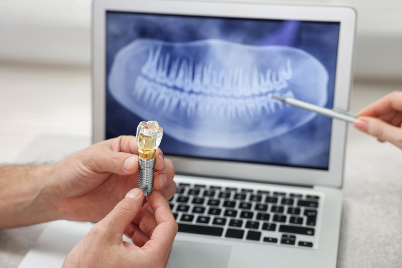 Navigating Your Path to a Bright Smile: Dental Implants in Webster, TX